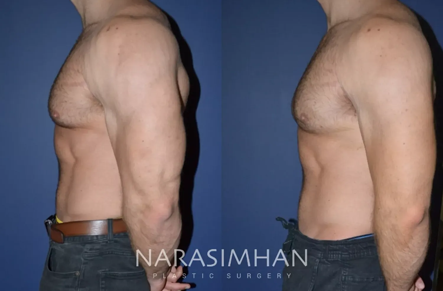 Body Contouring Before & After