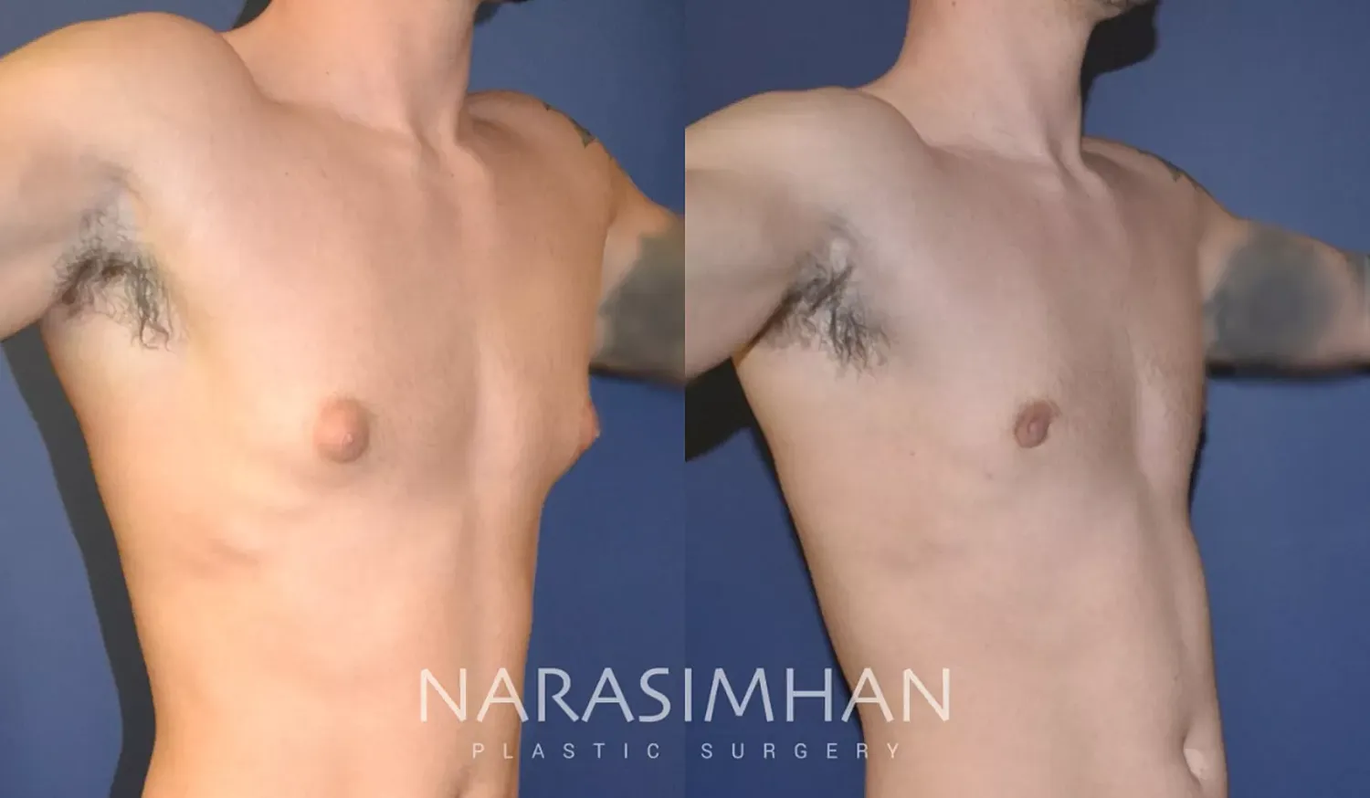 Body Contouring Before & After
