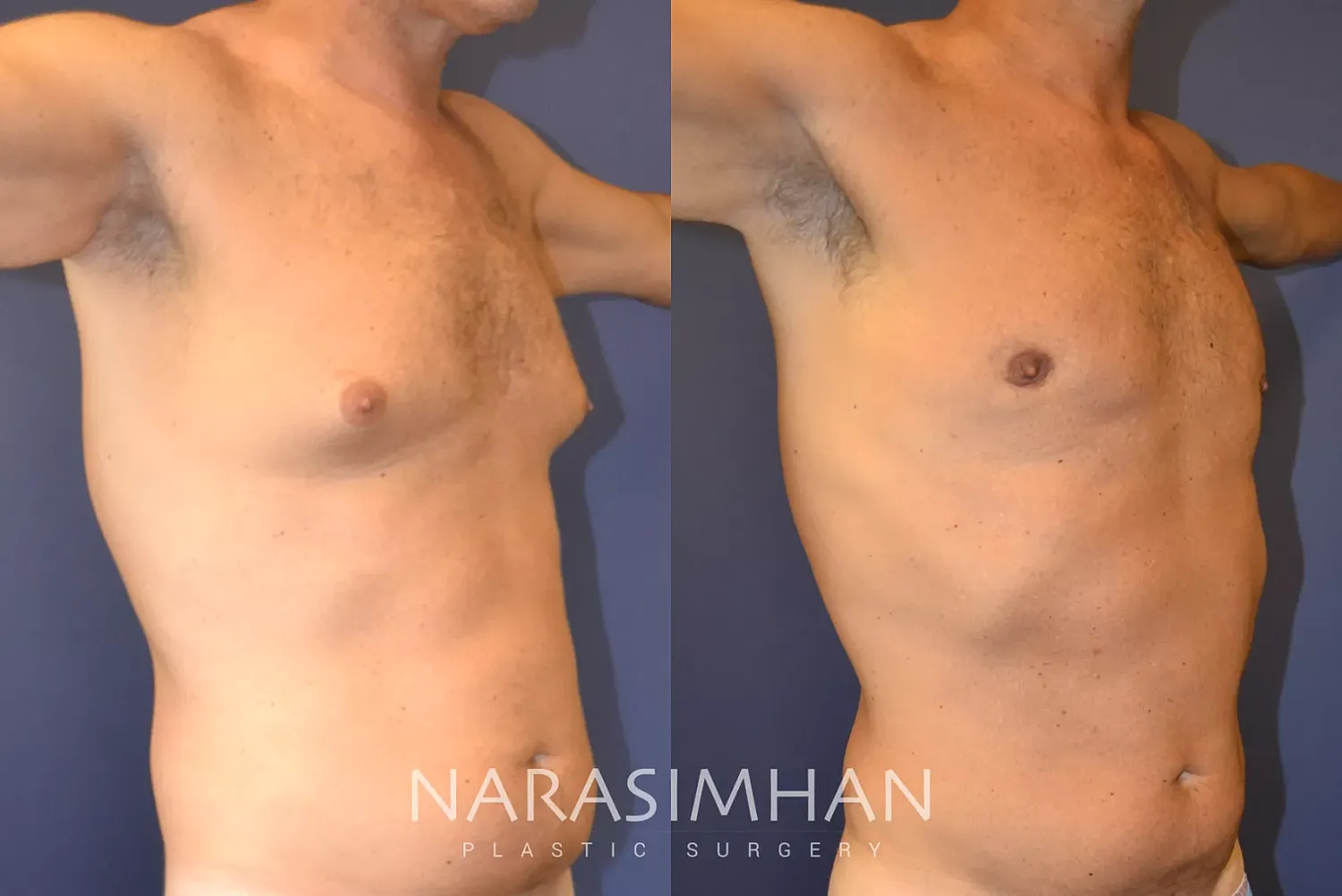 Body Contouring Before & After