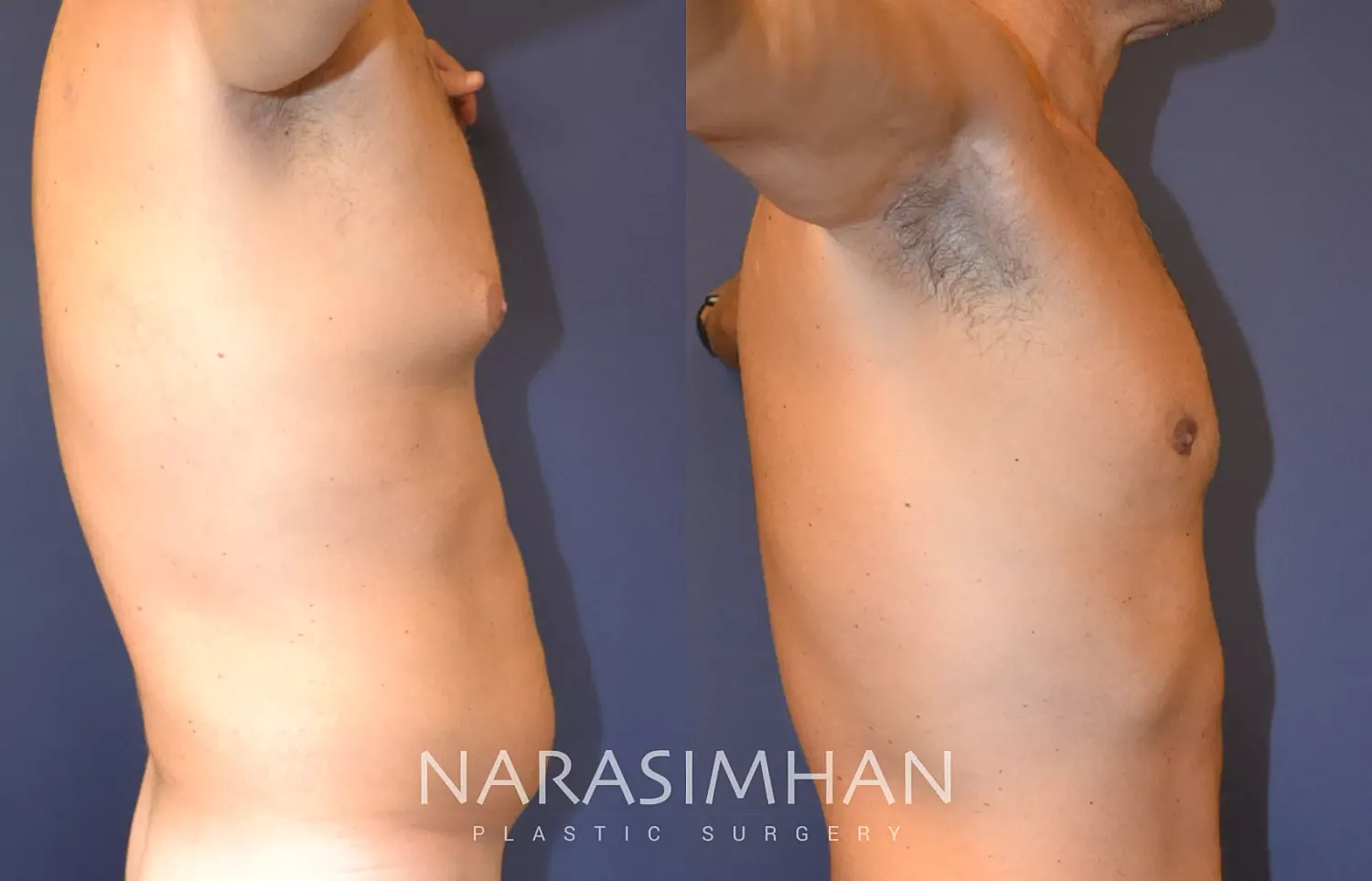 Body Contouring Before & After