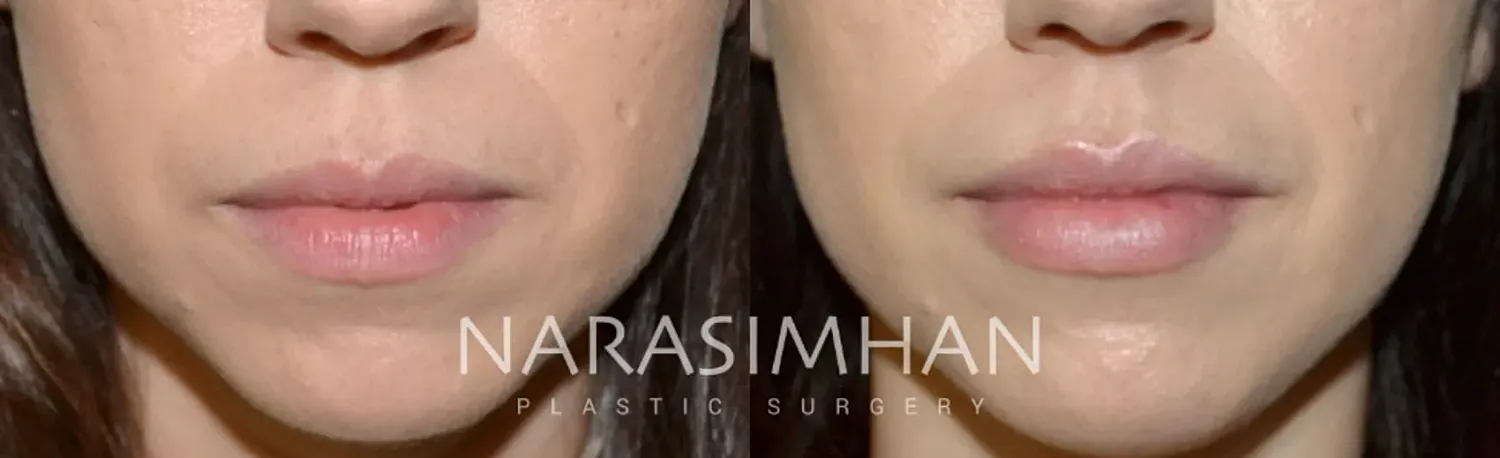 Dermal Filler Before & After