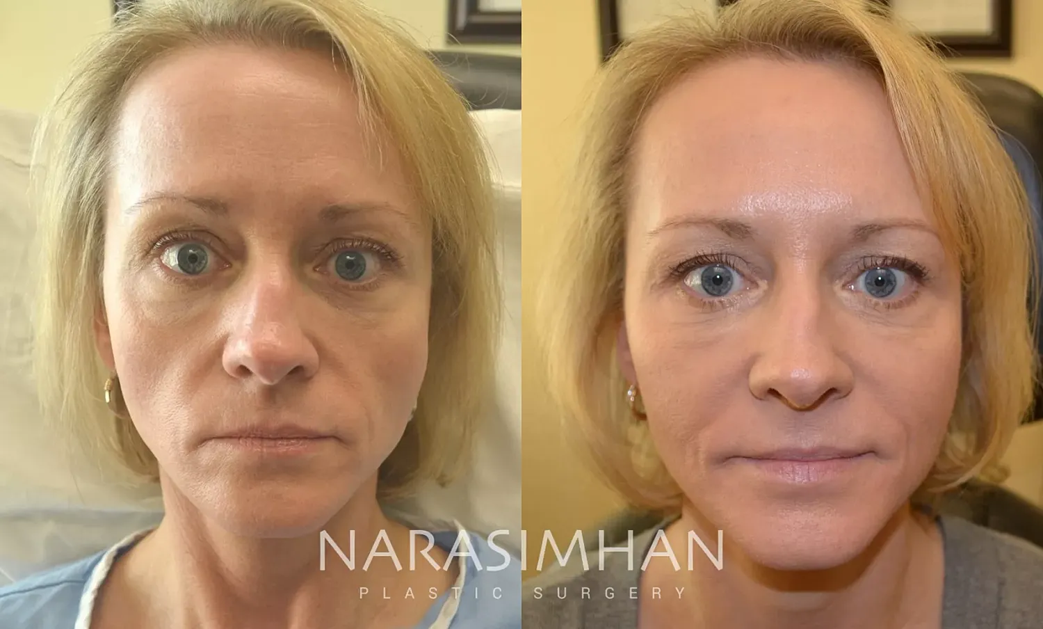 Dermal Filler Before & After