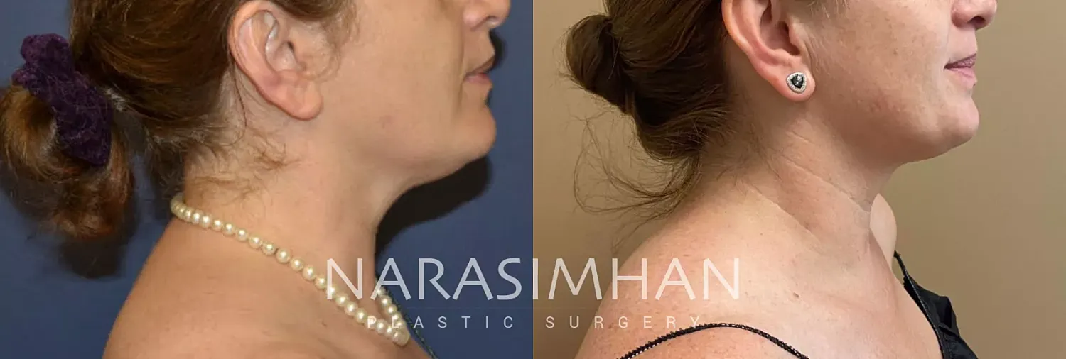 Coolsculpting Before & After