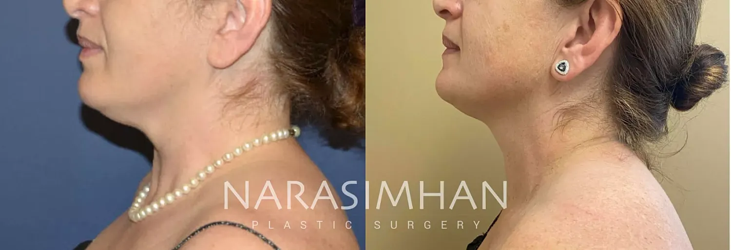 Coolsculpting Before & After