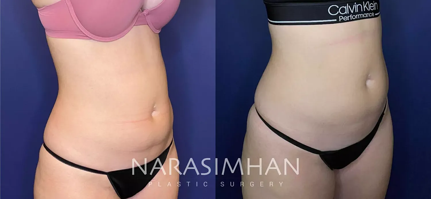 Coolsculpting Before & After