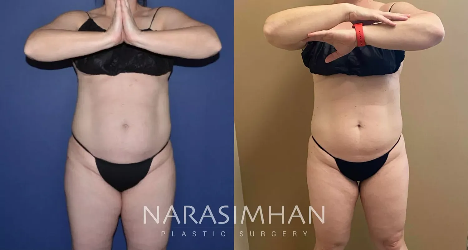 Coolsculpting Before & After