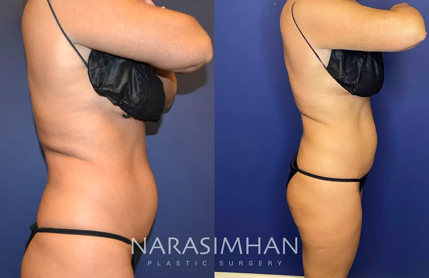 Coolsculpting Before & After