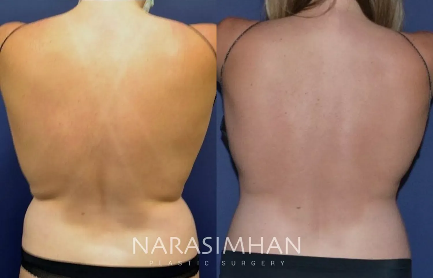 Coolsculpting Before & After