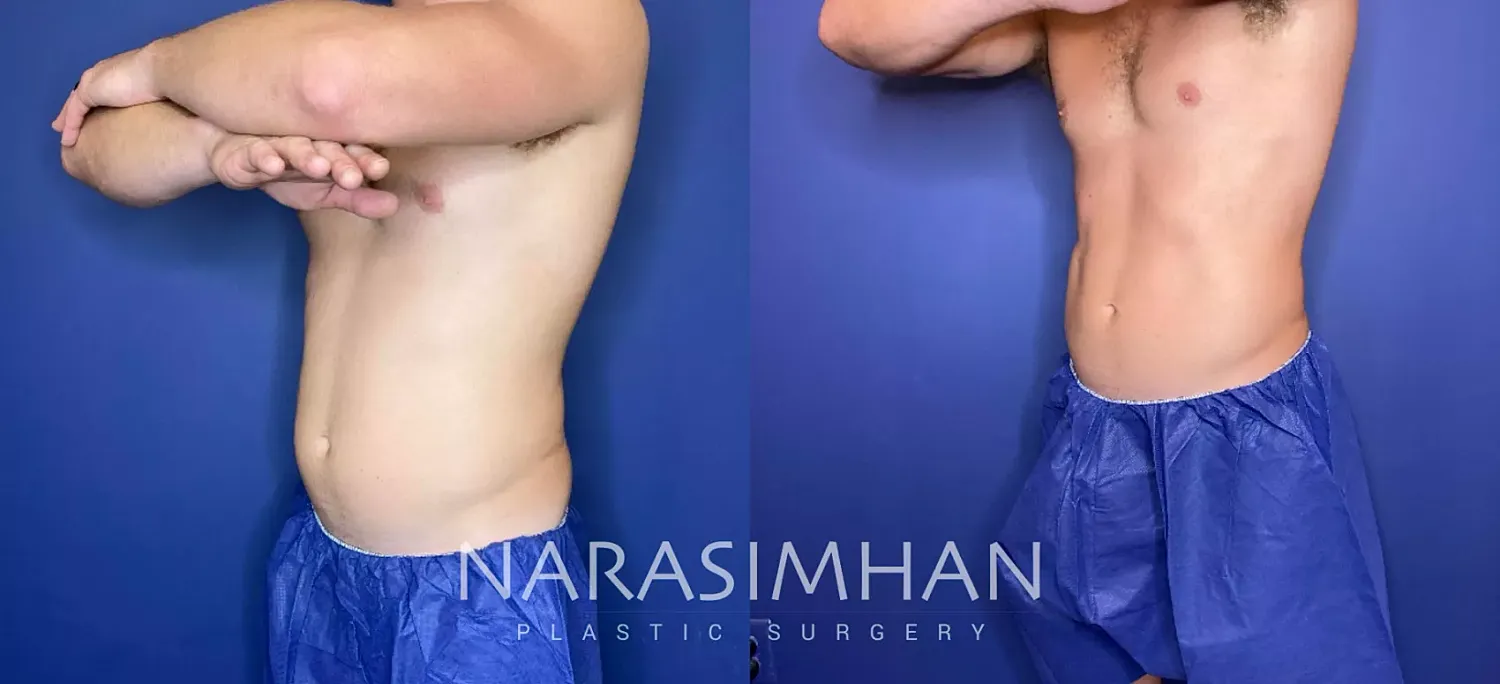 Coolsculpting Before & After