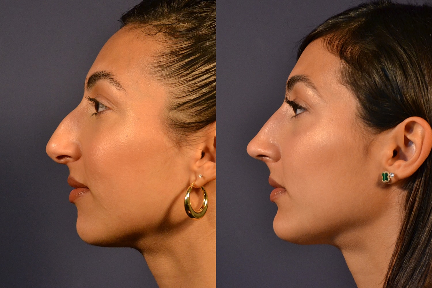 Profile comparison of facial features from both sides.