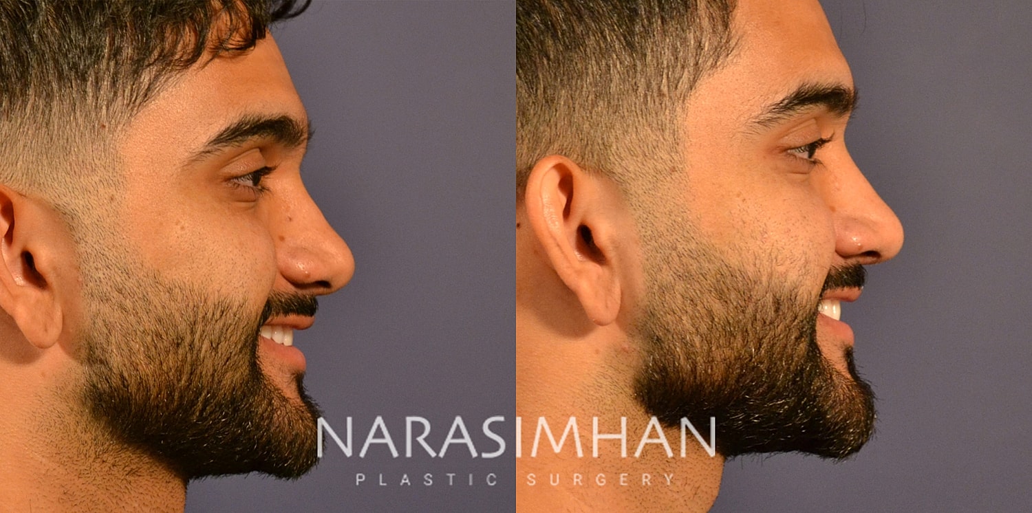 Rhinoplasty Before & After
