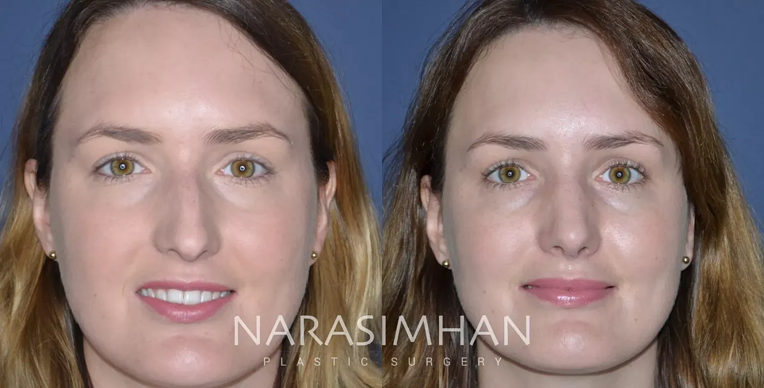 Rhinoplasty Before & After
