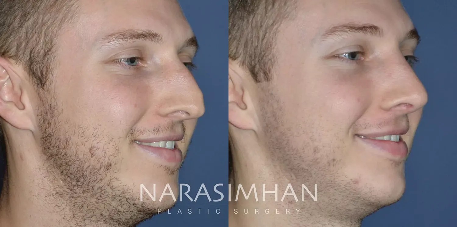Rhinoplasty Before & After