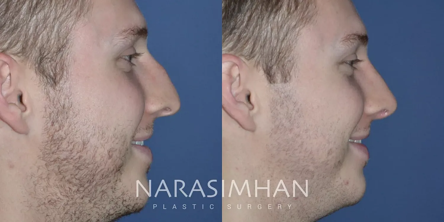 Rhinoplasty Before & After