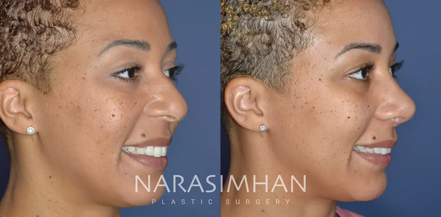 Rhinoplasty Before & After
