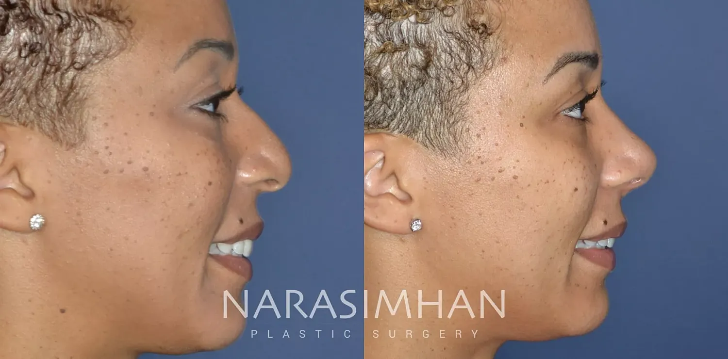 Rhinoplasty Before & After