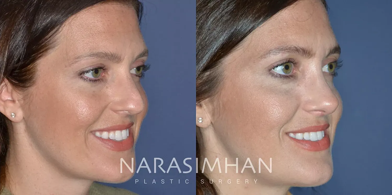Rhinoplasty Before & After