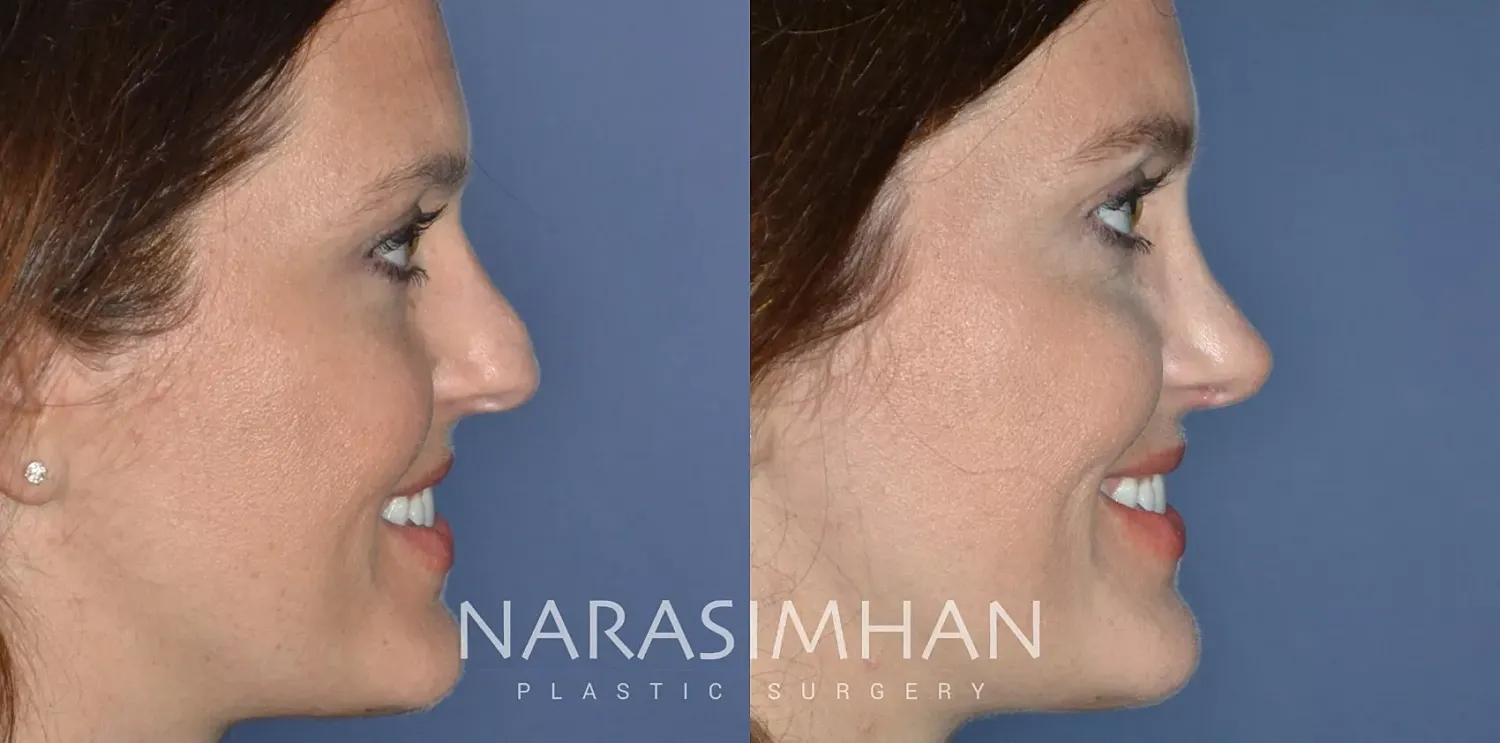Rhinoplasty Before & After