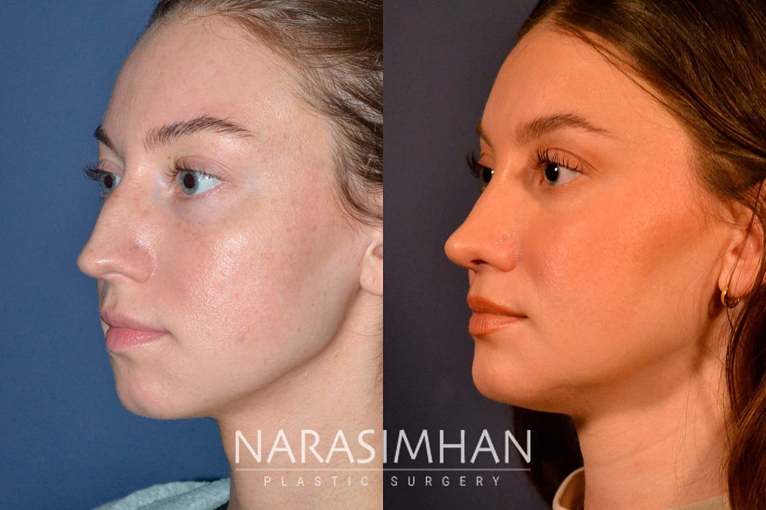 Rhinoplasty Before & After