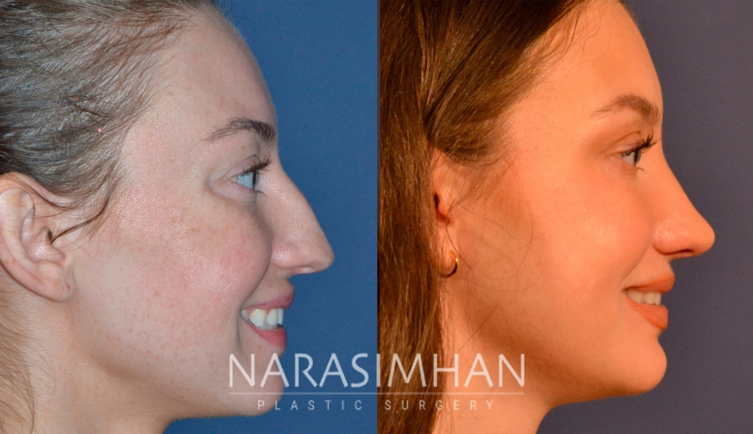 Rhinoplasty Before & After