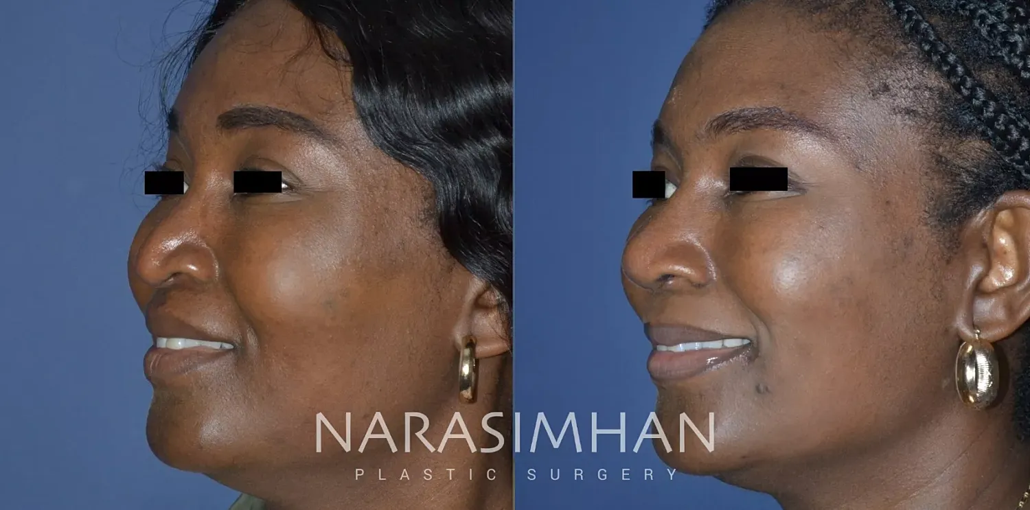 Rhinoplasty Before & After