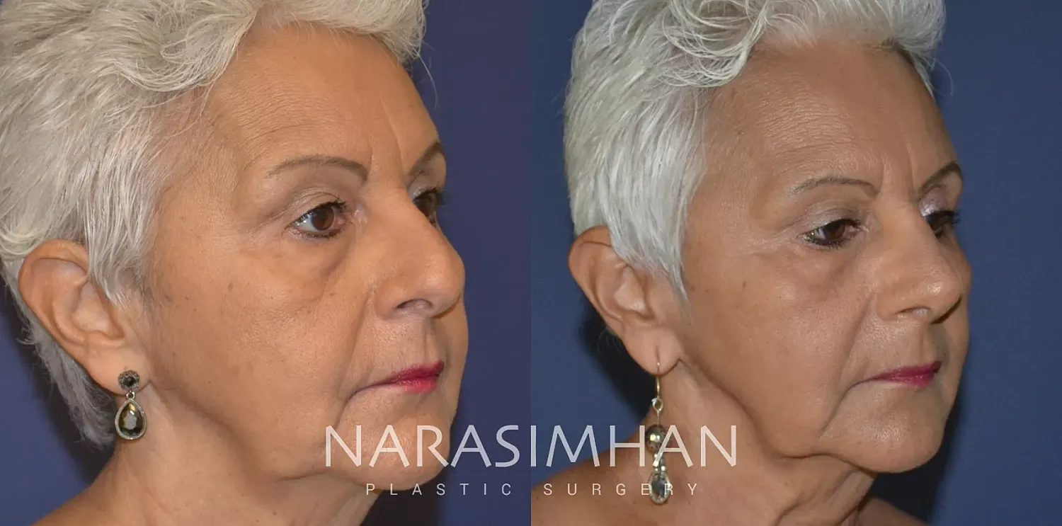 Rhinoplasty Before & After