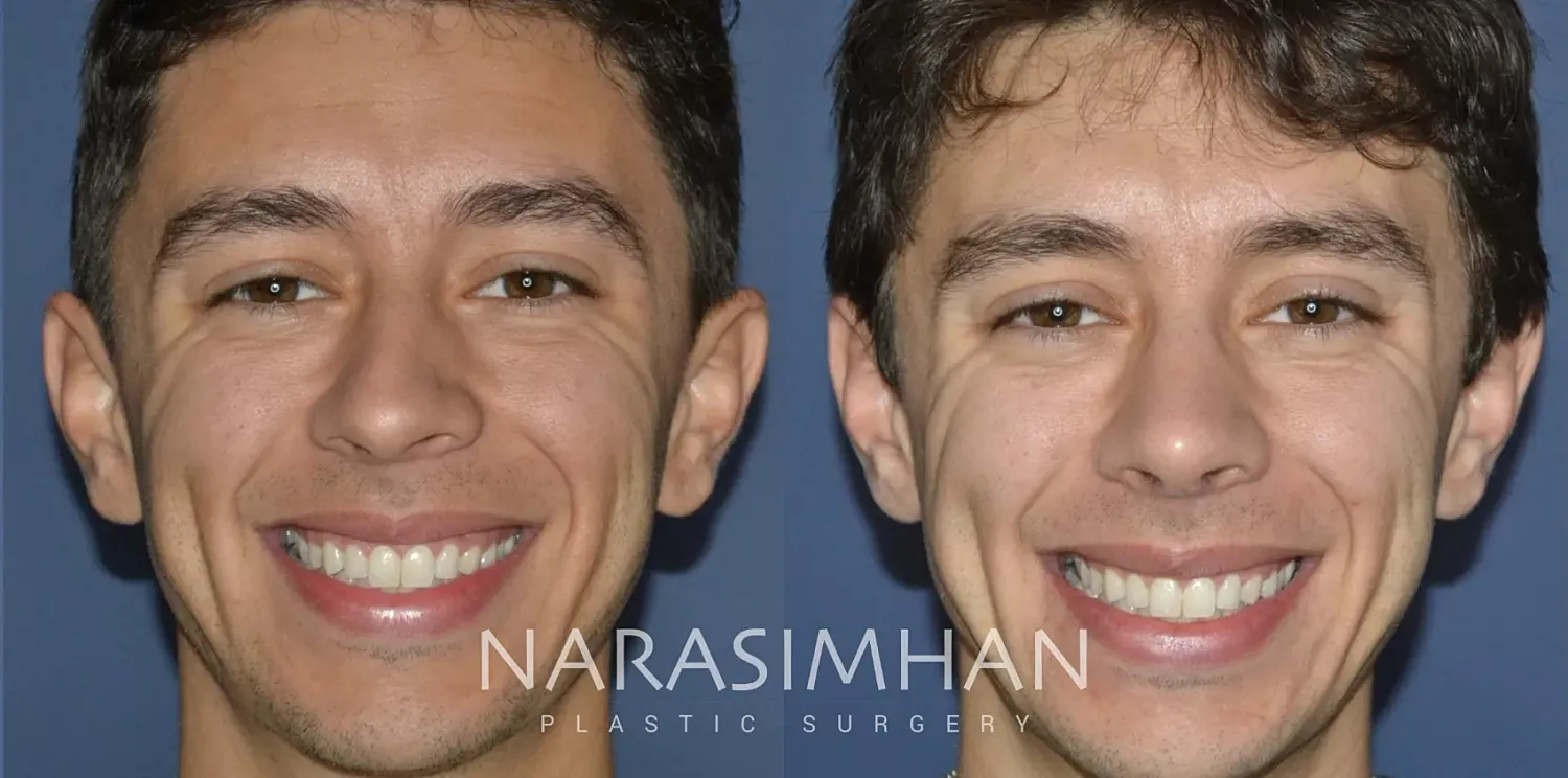 Rhinoplasty Before & After