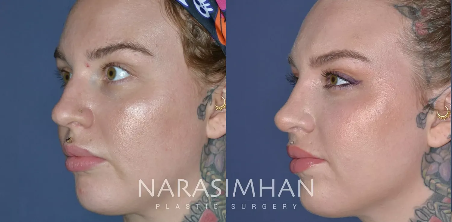 Rhinoplasty Before & After