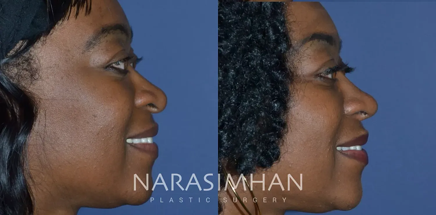 Rhinoplasty Before & After
