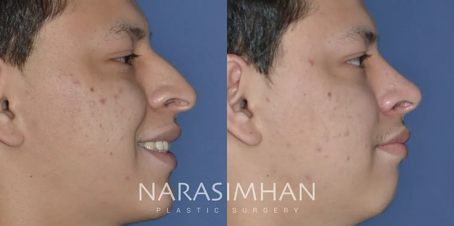 Rhinoplasty Before & After