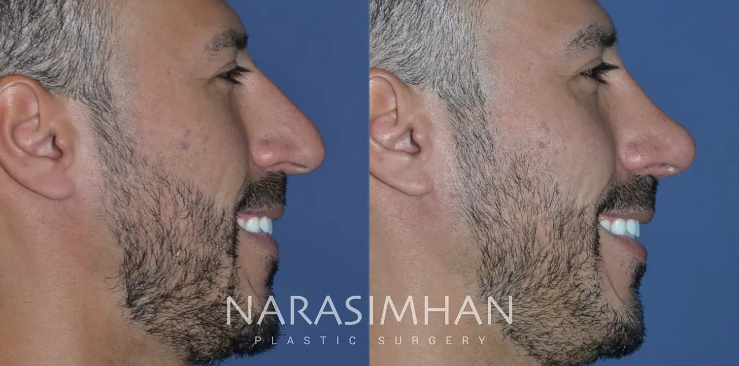 Rhinoplasty Before & After