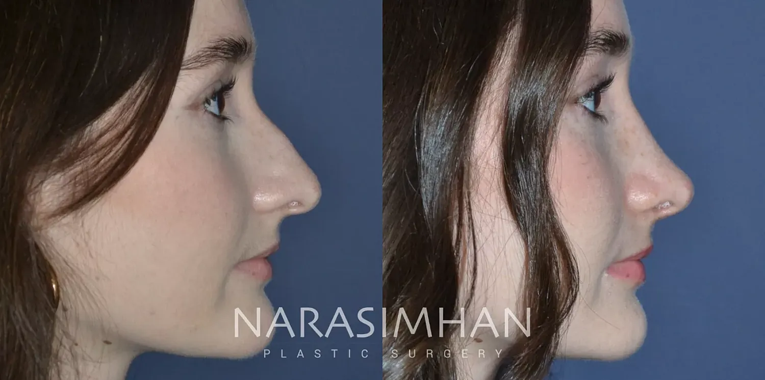 Rhinoplasty Before & After