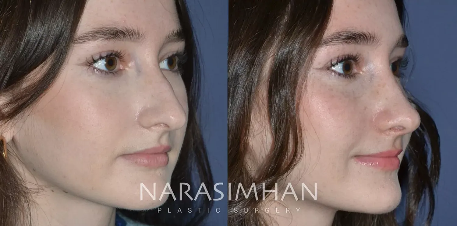 Rhinoplasty Before & After
