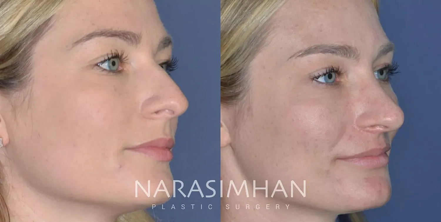 Rhinoplasty Before & After