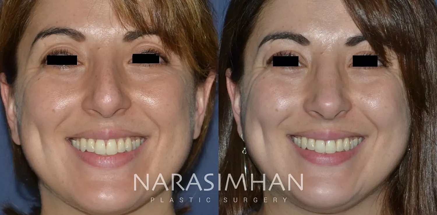 Rhinoplasty Before & After