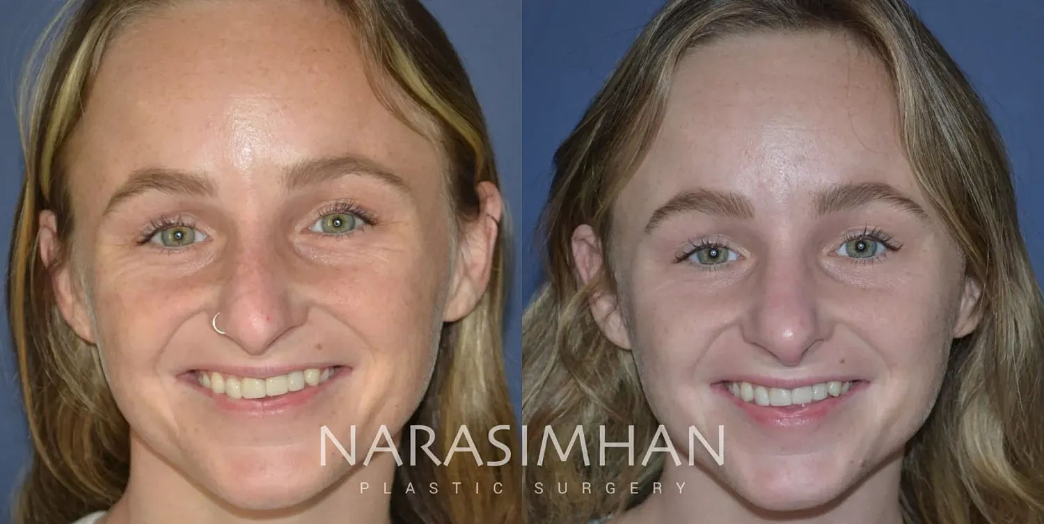 Rhinoplasty Before & After