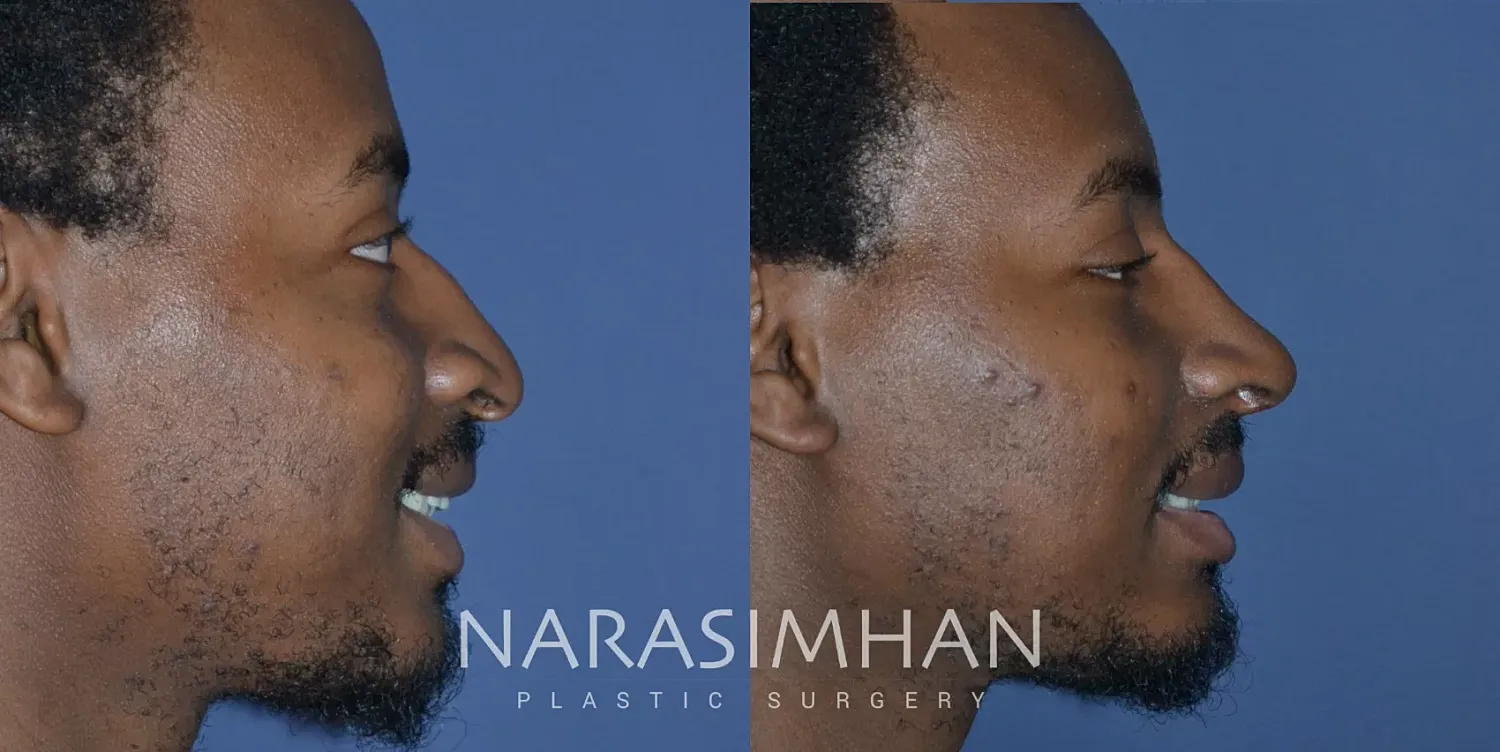 Rhinoplasty Before & After