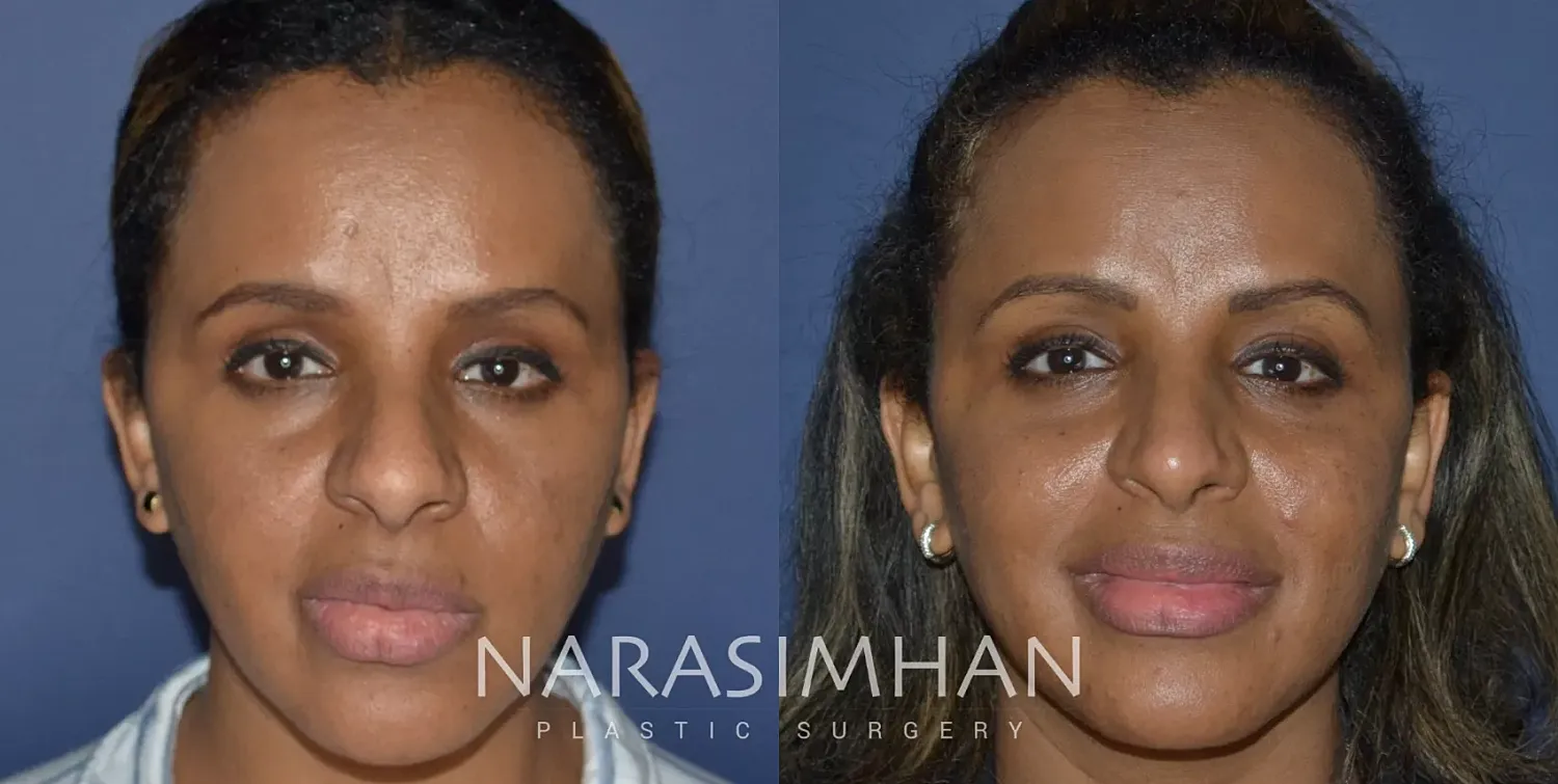 Rhinoplasty Before & After