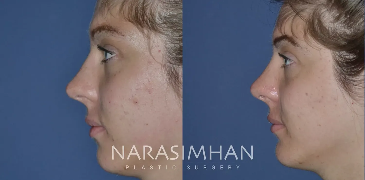 Rhinoplasty Before & After