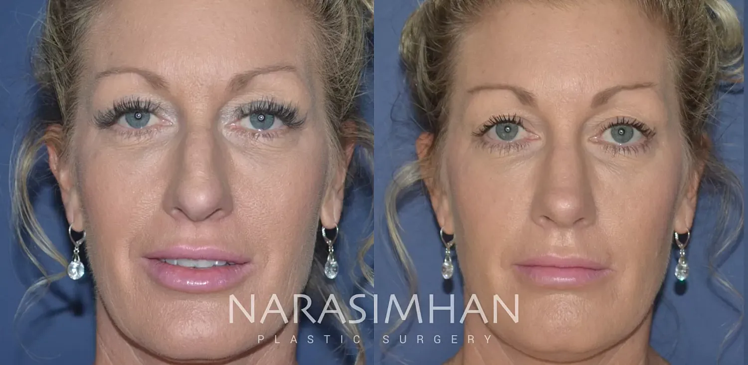 Rhinoplasty Before & After