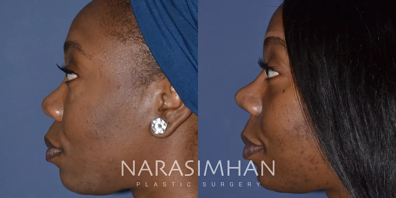 Rhinoplasty Before & After