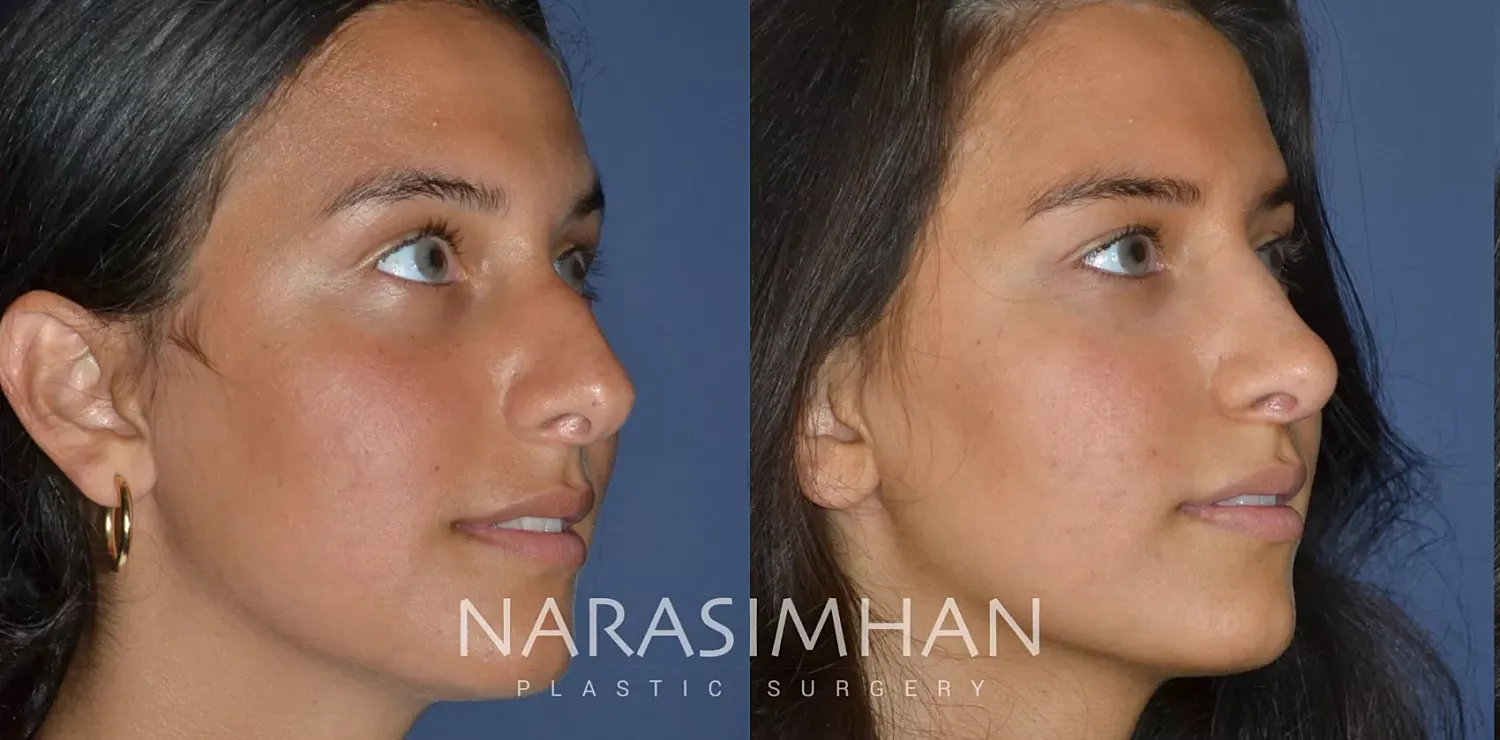 Rhinoplasty Before & After