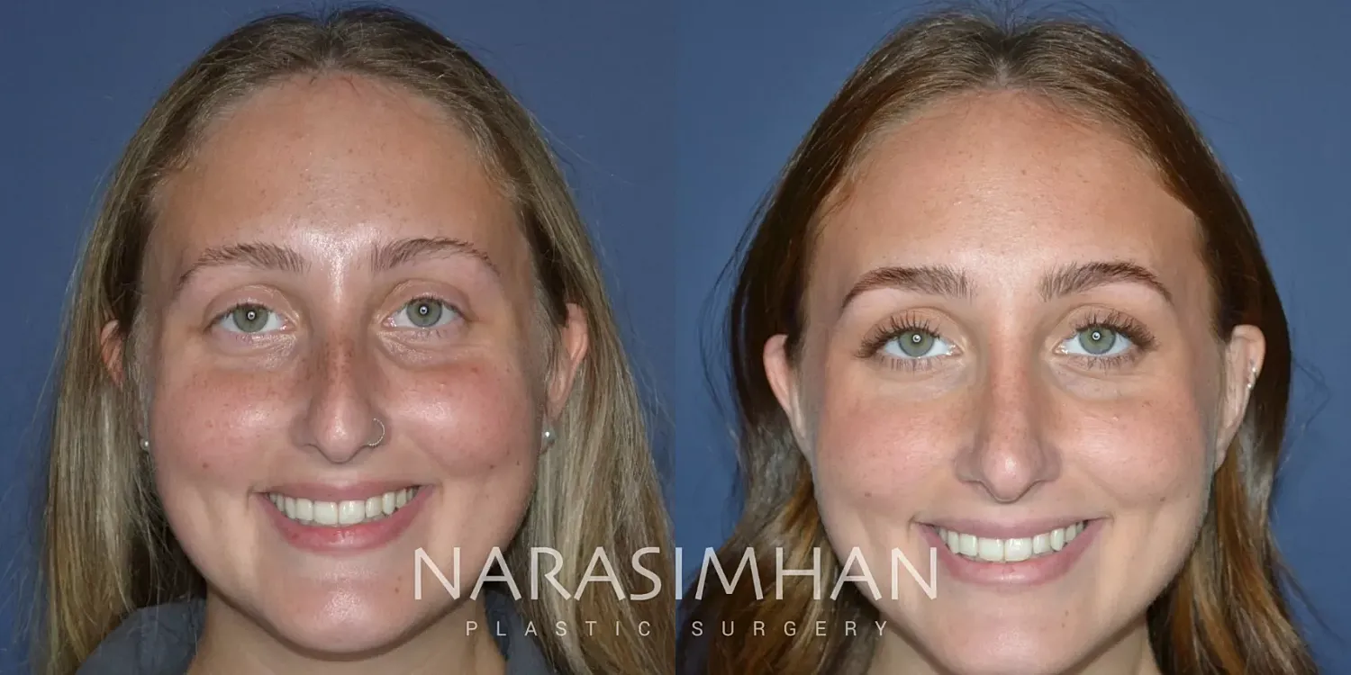 Rhinoplasty Before & After