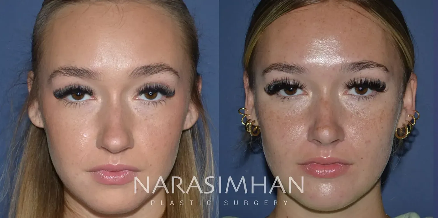 Rhinoplasty Before & After