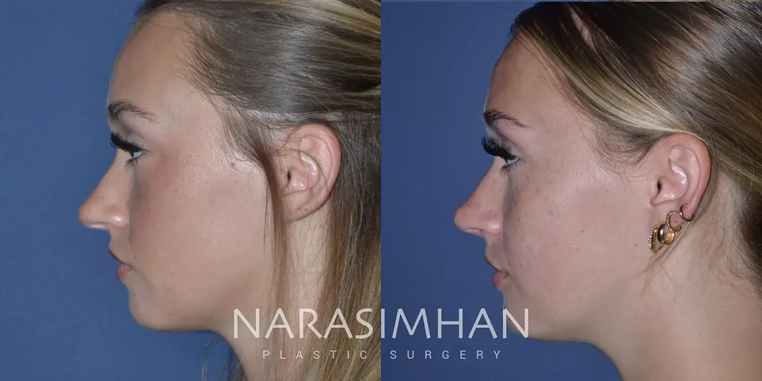 Rhinoplasty Before & After