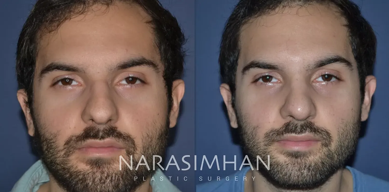Rhinoplasty Before & After