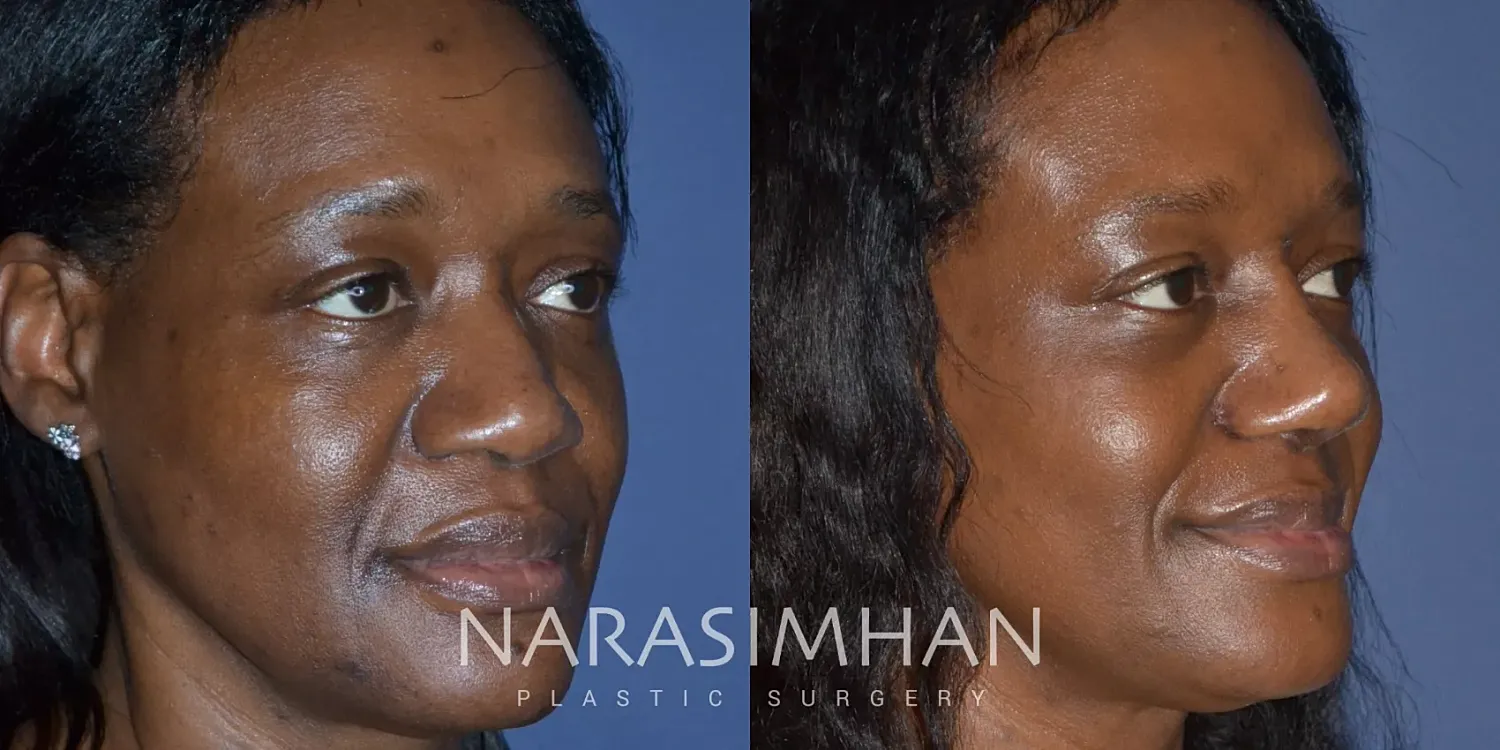 Rhinoplasty Before & After