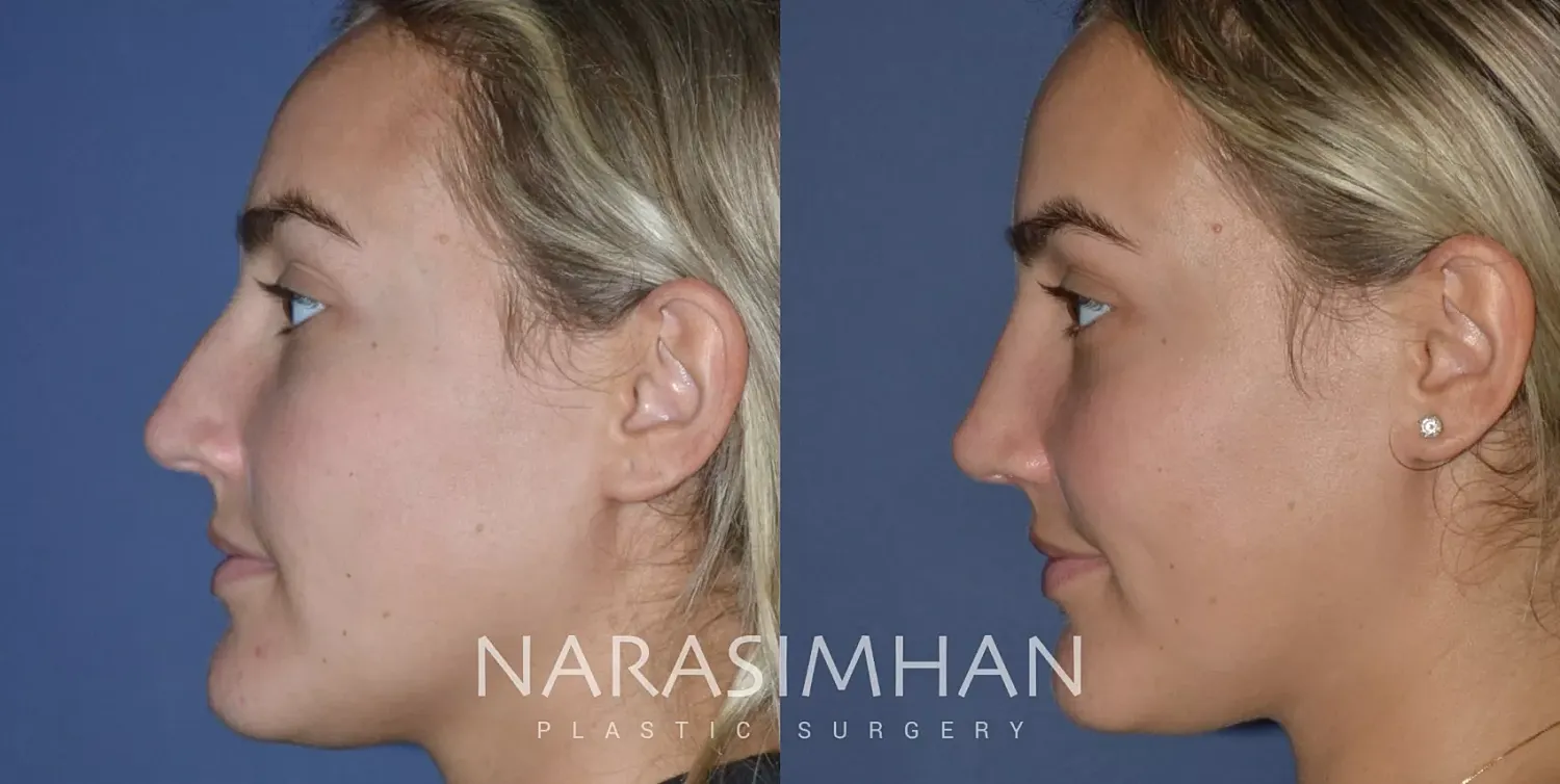 Rhinoplasty Before & After