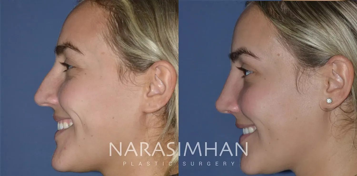 Rhinoplasty Before & After