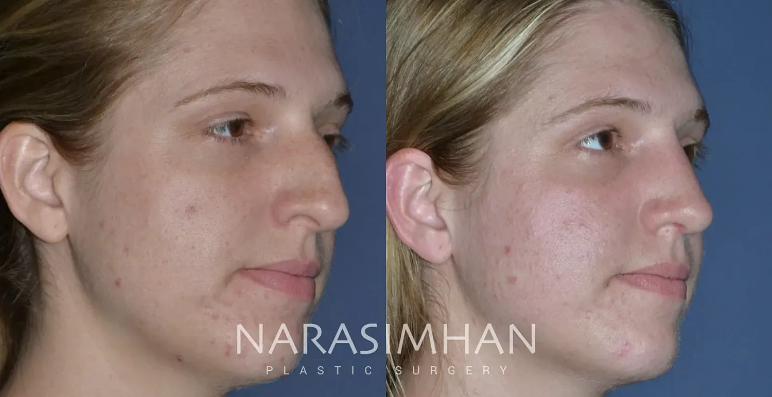 Rhinoplasty Before & After